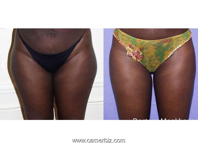 LIPOSUCCION DES CUISSES AU CAMEROUN - 1451