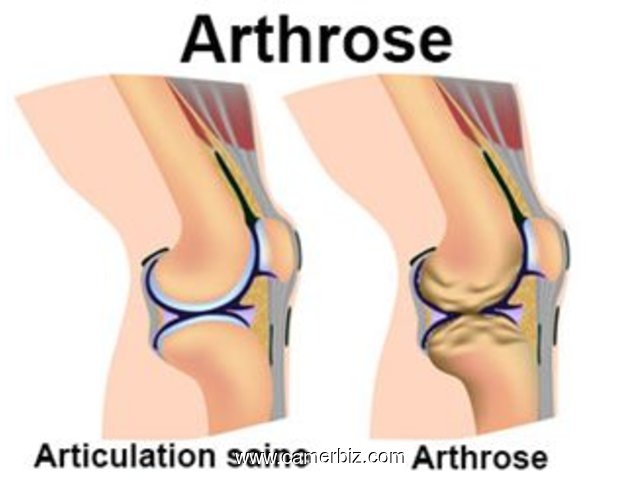 Rhumatismes Goutte Arthrite Drépanocytose Douleurs musculaires Traitement  - 17214