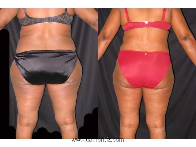 Chirurgie esthétique à Yaoundé et Douala  - 26736