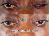 Pothèse oculaire au Cameroun - 35792