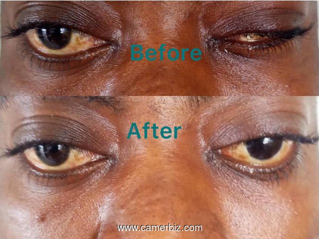 Pothèse oculaire au Cameroun - 35792