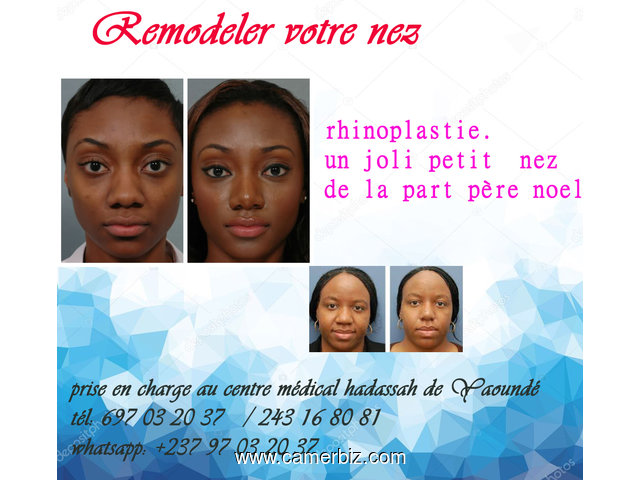  Remodeler votre nez au centre médical hadassah de Yaoundé. - 3839