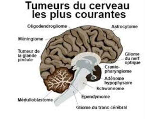 Traitement du cancer du cerveau - 591