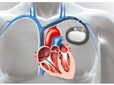 implantation d’un pacemaker - 592