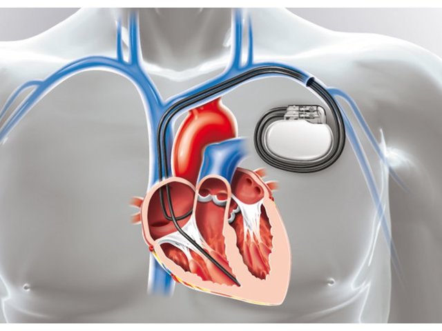implantation d’un pacemaker - 592
