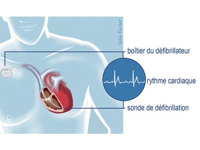 Défibrillateur automatique implantable - 595