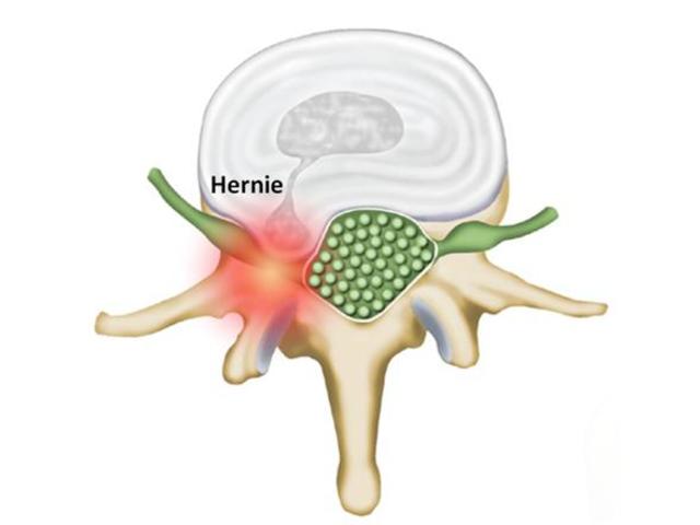 Traitement chirurgical des hernies discales lombaires - 597