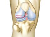 Traitement par prothèse de l’arthrose du genou - 599