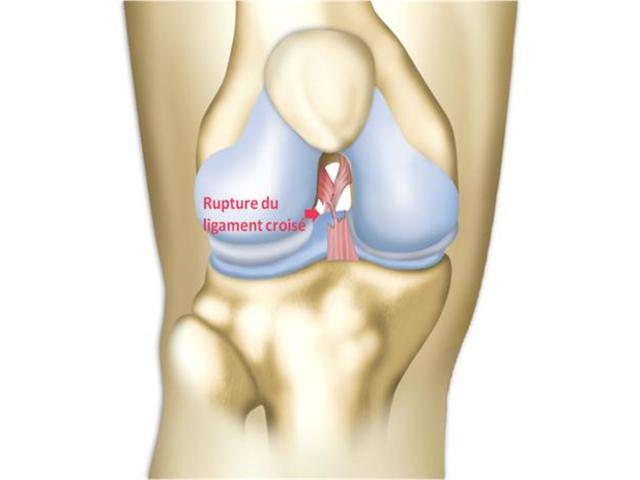 Traitement par prothèse de l’arthrose du genou - 599