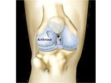 Traitement par prothèse de l’arthrose du genou - 599