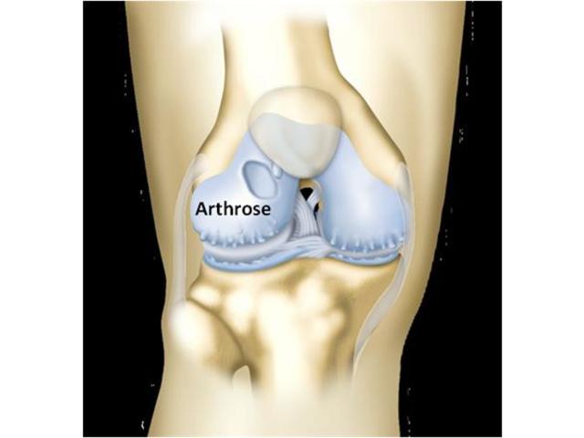 Traitement par prothèse de l’arthrose du genou - 599