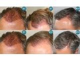 Implants de cheveux en Turquie - 604