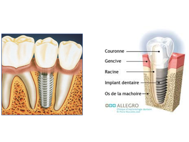 Implant dentaire - 618