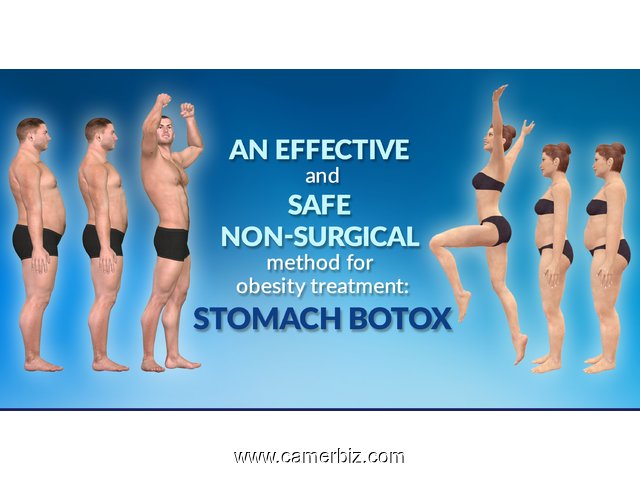 Botox estomac: Traitement non chirurgical efficace et sûr pour le traitement de l’obésité - 9269