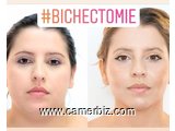 Des pommettes et une mâchoire de star avec la bichectomie