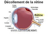  Décollement de la rétine