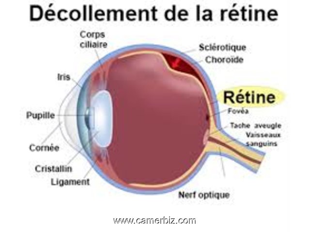  Décollement de la rétine - 9340