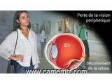  Décollement de la rétine - 9340