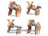 Traitement par prothèse de l’arthrose de la hanche