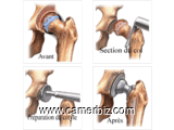 Traitement par prothèse de l’arthrose de la hanche - 9341